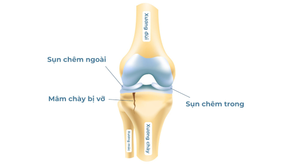 Tình trạng vỡ mâm chày